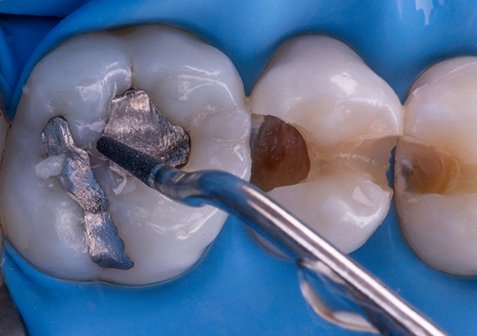 Remoção segura de amálgama