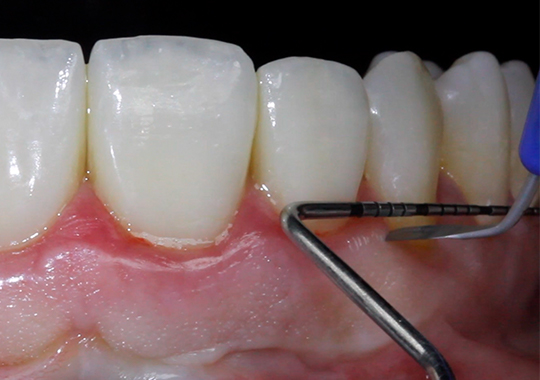 Cirurgia Parendodôntica