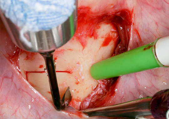 Levantamento de Seio com CVDentus