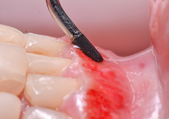 Peeling Gengival com CVDentus