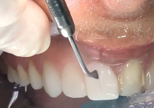 Remoção segura de facetas de contato com a CVDentus