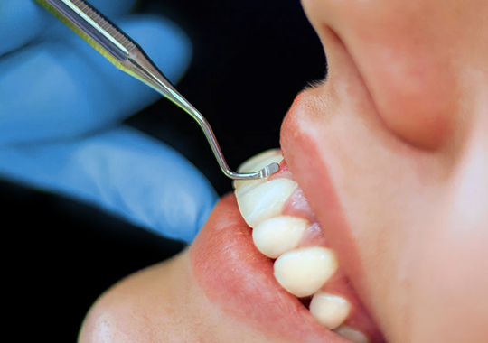 Raspagem periodontal