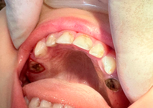 Extração-de-dentes-decíduos