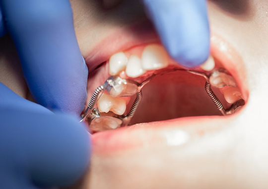 dentes caninos inclusos